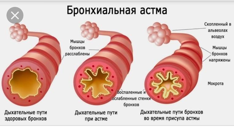 Все о бронхиальной астме